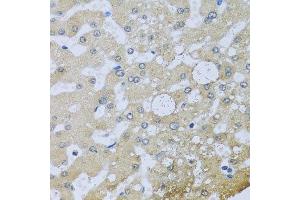 Immunohistochemistry of paraffin-embedded human liver injury using UQCR10 antibody at dilution of 1:100 (x40 lens). (UQCR10 抗体)
