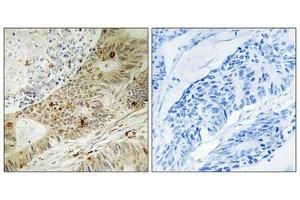 Immunohistochemistry analysis of paraffin-embedded human colon carcinoma tissue, using ATRIP (Phospho-Ser224) antibody. (ATRIP 抗体  (pSer224))