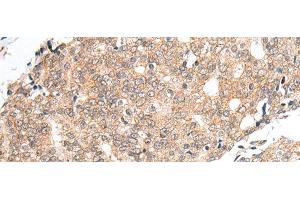 Immunohistochemistry of paraffin-embedded Human prost at e cancer tissue using PRELID1 Polyclonal Antibody at dilution of 1:40(x200) (PRELID1 抗体)
