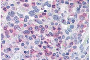 Human Spleen (formalin-fixed, paraffin-embedded) stained with UNC13D antibody ABIN290188 at 2. (UNC13D 抗体  (AA 1079-1090))