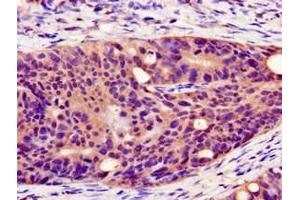 Immunohistochemistry of paraffin-embedded human colon cancer using ABIN7162886 at dilution of 1:100 (PLIN1 抗体  (AA 411-496))