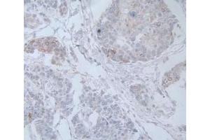 IHC-P analysis of Human Prostate Gland Cancer Tissue, with DAB staining. (IL-19 抗体  (AA 25-177))