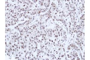 IHC-P Image Immunohistochemical analysis of paraffin-embedded A549 Xenograft, using HNF-1 alpha, antibody at 1:100 dilution. (HNF1A 抗体)