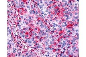 Anti-CELSR1 antibody IHC of human Breast, Carcinoma. (CELSR1 抗体  (N-Term))