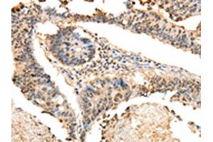 The image on the left is immunohistochemistry of paraffin-embedded Human colon cancer tissue using ABIN7130100(LRP12 Antibody) at dilution 1/25, on the right is treated with fusion protein. (LRP12 抗体)