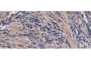Immunohistochemistry of paraffin-embedded Human brain tissue using ICA1 Polyclonal Antibody at dilution of 1:70(x200) (ICA1 抗体)