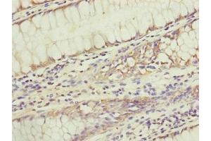 Immunohistochemistry of paraffin-embedded human colon cancer using ABIN7159945 at dilution of 1:100 (KIAA0391 抗体  (Catalytic Subunit))
