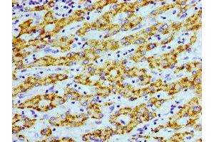 Immunohistochemistry of paraffin-embedded human liver cancer using ABIN7168945 at dilution of 1:100 (AGXT 抗体  (AA 112-294))