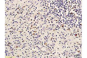 Formalin-fixed and paraffin embedded human cervical carcinoma labeled with Anti-ErbB-3/HER3 Polyclonal Antibody, Unconjugated (ABIN686767) followed by conjugation to the secondary antibody and DAB staining (ERBB3 抗体  (AA 661-760))