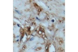 Immunohistochemical analysis of 4EBP1 staining in human prostate cancer formalin fixed paraffin embedded tissue section. (eIF4EBP1 抗体  (N-Term))