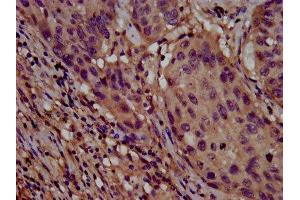 IHC image of ABIN7147931 diluted at 1:800 and staining in paraffin-embedded human lung cancer performed on a Leica BondTM system. (CLPTM1L 抗体  (AA 32-172))