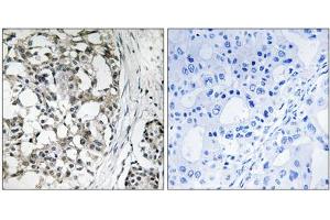Immunohistochemistry analysis of paraffin-embedded human breast carcinoma tissue using PEX14 antibody. (PEX14 抗体  (Internal Region))
