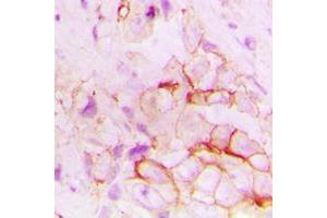 Immunohistochemical analysis of CD143 staining in human breast cancer formalin fixed paraffin embedded tissue section.