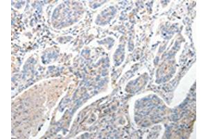 The image on the left is immunohistochemistry of paraffin-embedded Human lung cancer tissue using ABIN7190682(FOXD1 Antibody) at dilution 1/25, on the right is treated with synthetic peptide. (FOXD1 抗体)