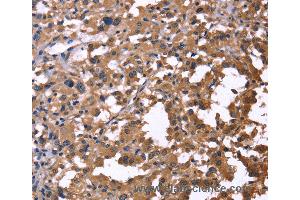 Immunohistochemistry of Human thyroid cancer using IL1A Polyclonal Antibody at dilution of 1:60 (IL1A 抗体)