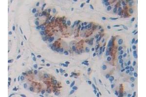 Detection of FBLN4 in Human Stomach cancer Tissue using Polyclonal Antibody to Fibulin 4 (FBLN4) (FBLN4 抗体  (AA 26-443))