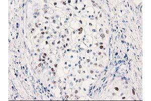 Immunohistochemical staining of paraffin-embedded Carcinoma of Human pancreas tissue using anti-TP53 mouse monoclonal antibody. (p53 抗体)