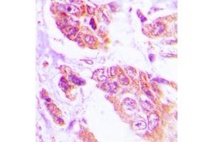Immunohistochemical analysis of NGEP staining in human lung cancer formalin fixed paraffin embedded tissue section.