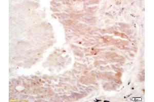 Formalin-fixed and paraffin embedded human lung carcinoma labeled with Rabbit Anti Cullin/C10orf46 Polyclonal Antibody, Unconjugated (ABIN670896) at 1:200 followed by conjugation to the secondary antibody and DAB staining (CACUL1 抗体  (AA 181-248))