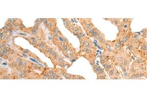 Immunohistochemistry of paraffin-embedded Human thyroid cancer tissue using CECR1 Polyclonal Antibody at dilution of 1:40(x200) (CECR1 抗体)