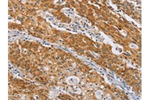 The image on the left is immunohistochemistry of paraffin-embedded Human gastic cancer tissue using ABIN7190211(CENPE Antibody) at dilution 1/50, on the right is treated with synthetic peptide. (CENPE 抗体)