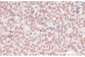 Immunohistochemistry of paraffin-embedded Human oophoroma using SNRNP70 Polyclonal Antibody at dilution of 1:100 (40x lens). (SNRNP70 抗体)