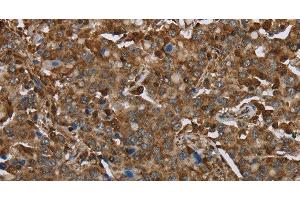 Immunohistochemistry of paraffin-embedded Human liver cancer using ARHGDIA Polyclonal Antibody at dilution of 1:30 (ARHGDIA 抗体)