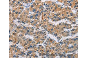 Immunohistochemistry of Human gastric cancer using CERK Polyclonal Antibody at dilution of 1:30 (CERK 抗体)