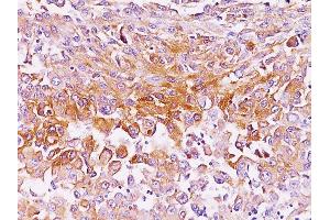 Formalin-fixed, paraffin-embedded human Melanoma stained with gp100 Monoclonal Antibody (SPM286). (Melanoma gp100 抗体)