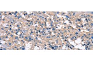 Immunohistochemistry of paraffin-embedded Human thyroid cancer tissue using ZFYVE16 Polyclonal Antibody at dilution of 1:60(x200) (ZFYVE16 抗体)