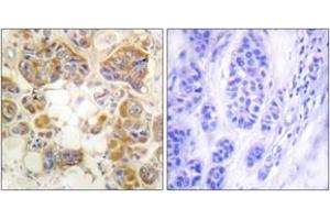 Immunohistochemistry analysis of paraffin-embedded human breast carcinoma tissue, using Collagen I Antibody. (Collagen Type I 抗体  (AA 1-50))