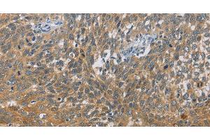 Immunohistochemistry of paraffin-embedded Human cervical cancer tissue using DIO1 Polyclonal Antibody at dilution 1:60 (DIO1 抗体)