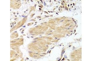 Immunohistochemistry of paraffin-embedded Human gastric cancer using Caspase-2 Polyclonal Antibody at dilution of 1:100 (40x lens). (Caspase 2 抗体)