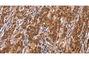 Immunohistochemistry of paraffin-embedded Human gasrtic cancer tissue using TDP2 Polyclonal Antibody at dilution 1:40 (TDP2 抗体)