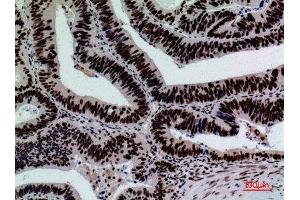 Immunohistochemistry (IHC) analysis of paraffin-embedded Human Colon Cancer, antibody was diluted at 1:100.