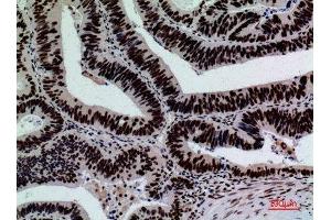Immunohistochemistry (IHC) analysis of paraffin-embedded Human Colon Cancer, antibody was diluted at 1:100. (SIGLEC7 抗体  (Internal Region))