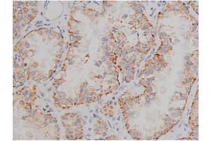 ABIN6267496 at 1/200 staining Human lung cancer tissue sections by IHC-P. (SNCA 抗体  (pSer129))