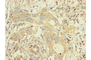 Immunohistochemistry of paraffin-embedded human pancreatic cancer using ABIN7173107 at dilution of 1:100 (TMEM184B 抗体  (AA 311-407))
