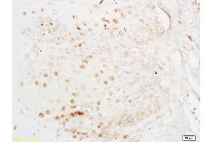 Formalin-fixed and paraffin embedded human esophageal carcinoma labeled with Anti-ELAVL1/HUR Polyclonal Antibody, Unconjugated (ABIN748583) at 1:200 followed by conjugation to the secondary antibody and DAB staining (ELAVL1 抗体)