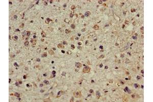 Immunohistochemistry of paraffin-embedded human glioma using ABIN7147710 at dilution of 1:100 (CDYL 抗体  (AA 8-260))