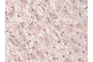 Detection of GCA in Human Glioma Tissue using Polyclonal Antibody to Grancalcin (GCA) (Grancalcin 抗体  (AA 1-139))