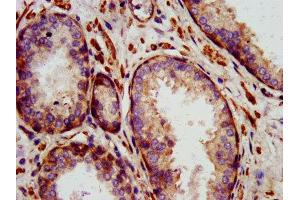 IHC image of ABIN7156872 diluted at 1:1400 and staining in paraffin-embedded human prostate cancer performed on a Leica BondTM system. (IL-24 抗体  (AA 52-207))