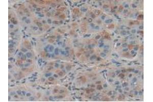 IHC-P analysis of Human Liver Cancer Tissue, with DAB staining. (FASL 抗体  (AA 103-281))