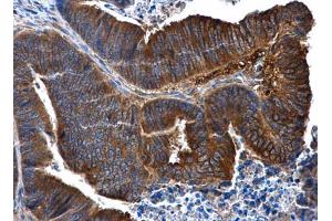 IHC-P Image IL1 Receptor 2 antibody [N3C3] detects IL1 Receptor 2 protein at cytoplasm in human colon cancer by immunohistochemical analysis. (IL1R2 抗体)