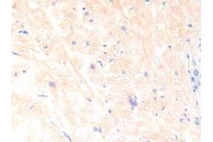 Detection of IL13 in Human Prostate Tissue using Polyclonal Antibody to Interleukin 13 (IL13) (IL-13 抗体  (AA 25-146))