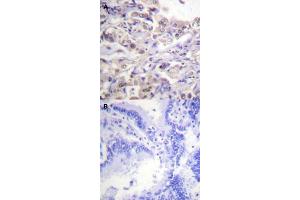 Immunohistochemical staining (Formalin-fixed paraffin-embedded sections) of human lung cancer tissue with HNRNPD (phospho S83) polyclonal antibody  without blocking peptide (A) or preincubated with blocking peptide (B) under 1:50-1:100 dilution. (HNRNPD/AUF1 抗体  (pSer83))