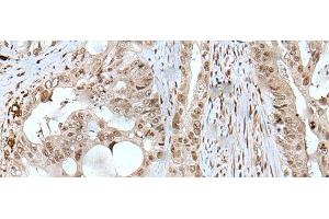 Immunohistochemistry of paraffin-embedded Human colorectal cancer tissue using USP3 Polyclonal Antibody at dilution of 1:50(x200) (USP3 抗体)