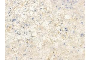 ABIN6255949 and ABIN6267455 at 1/100 staining human astrocytoma by IHC-P. (SHP1 抗体  (pTyr536))