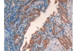 Detection of GAL2 in Human Thyroid cancer Tissue using Polyclonal Antibody to Galectin 2 (GAL2) (Galectin 2 抗体  (AA 1-132))