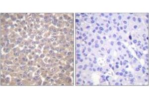 Immunohistochemistry analysis of paraffin-embedded human breast carcinoma tissue, using TRADD Antibody.